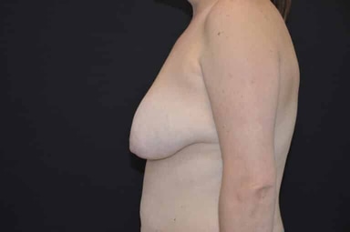 Breast lift with implants patient 27 before photo