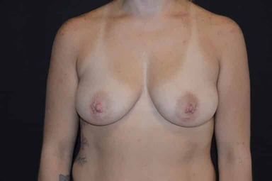Breast lift with implants patient 25 before photo
