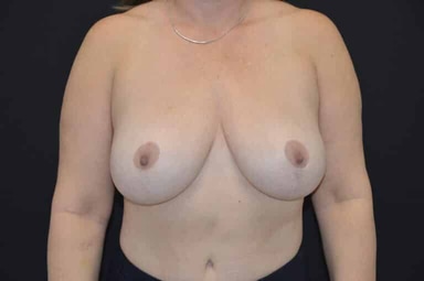 Breast lift with implants patient 32 after photo