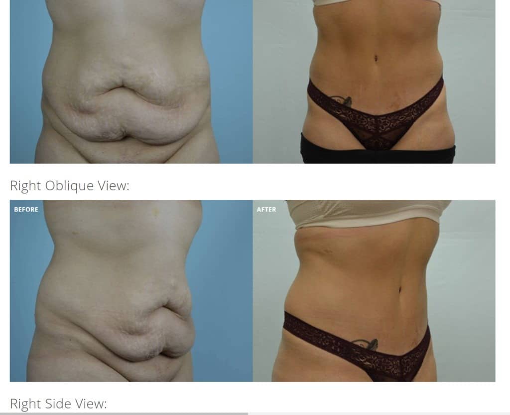 About Tummy Tuck (Abdominoplasty) Plastic Surgery