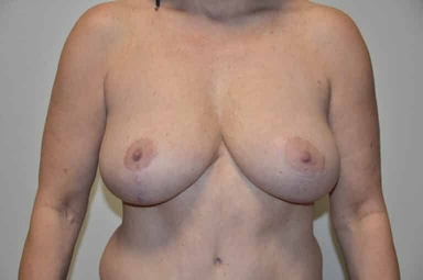 Breast lift with implants patient 34 after photo