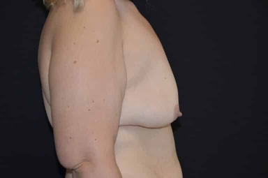 Breast lift with implants patient 15 before photo