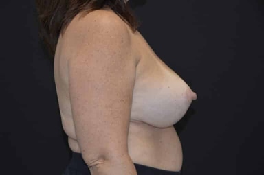Breast lift with implants patient 4 after photo