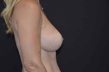 Breast lift with implants patient 29 after photo