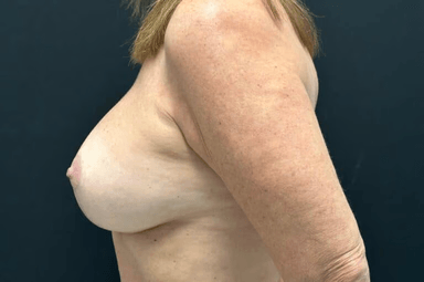 Breast lift with implants patient 27 after photo