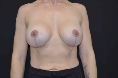 Breast lift with implants patient 28 after photo