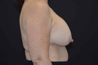Breast lift with implants patient 4 before photo