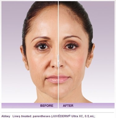 Dermal Fillers (Juvéderm®, Voluma®, Restylane®, Radiesse®, Belotero®)
