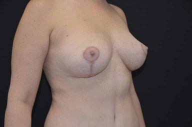 Breast lift with implants patient 22 after photo
