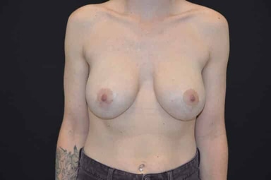 Breast lift with implants patient 27 after photo