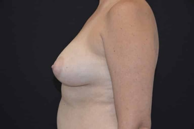 Breast lift with implants patient 22 before photo
