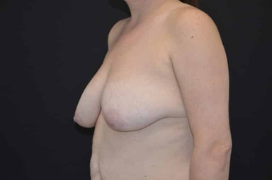 Breast lift with implants patient 27 before photo