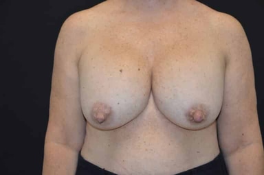Breast lift with implants patient 4 before photo
