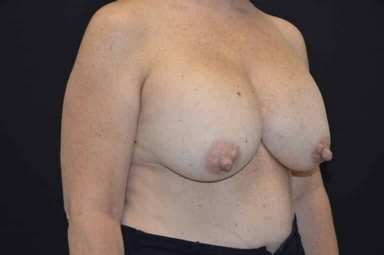 Breast lift with implants patient 4 before photo