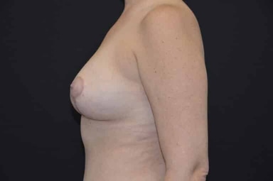 Breast lift with implants patient 22 after photo