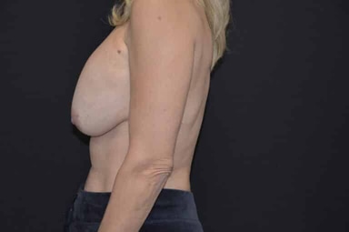 Breast lift with implants patient 29 before photo