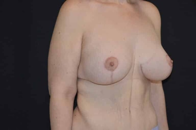 Breast lift with implants patient 15 after photo
