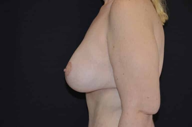Breast lift with implants patient 15 after photo
