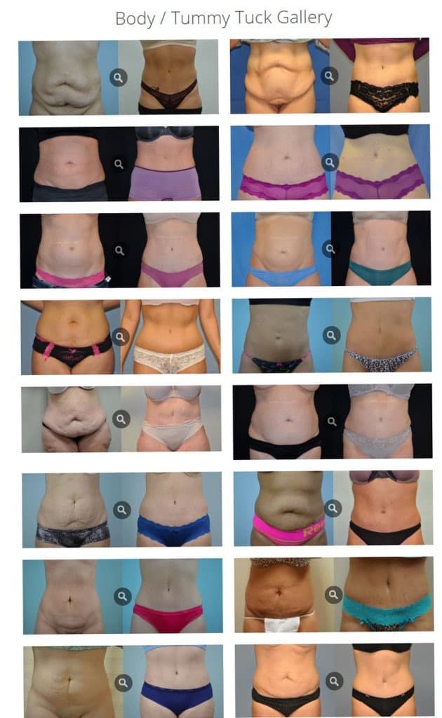 Tummy Tuck (Abdominoplasty) Plastic Surgery Before And After Pictures