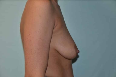 Breast lift with implants patient 27 before photo