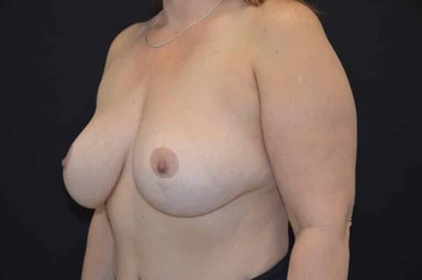 Breast lift with implants patient 32 after photo