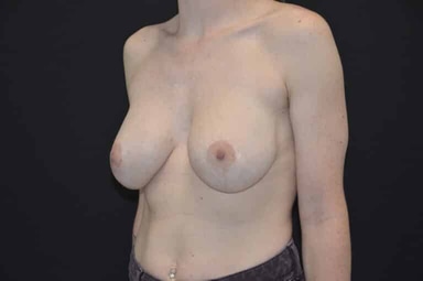 Breast lift with implants patient 27 after photo