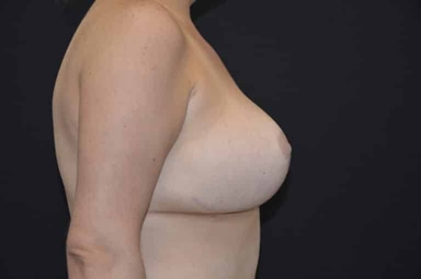 Breast lift with implants patient 27 after photo