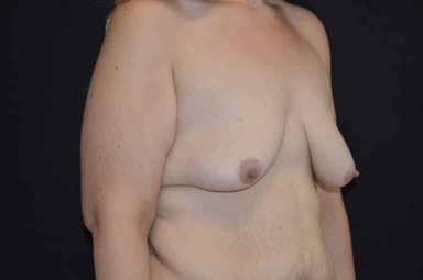 Breast lift with implants patient 15 before photo