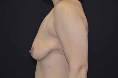 Breast lift with implants patient 21 before photo
