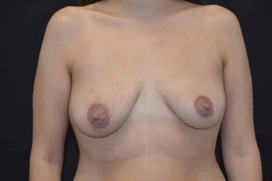 Breast lift with implants patient 2 before photo