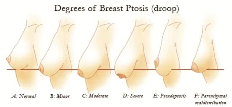 Do I need a breast lift or can I just do implants?