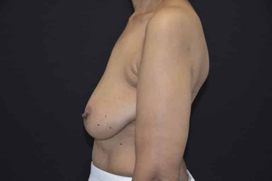 Breast lift with implants patient 7 before photo