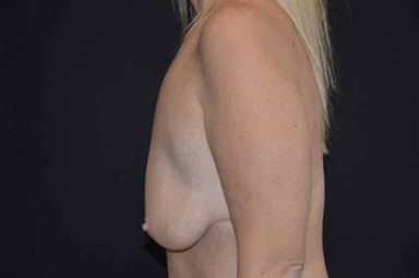 Breast lift with implants patient 18 before photo