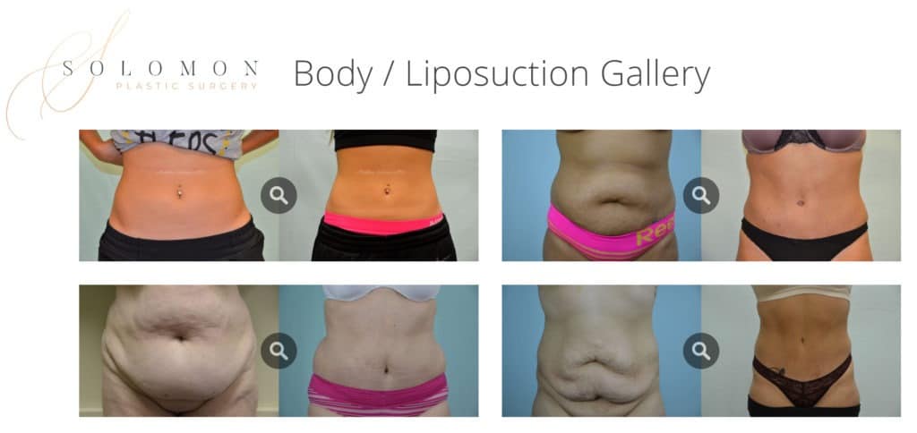Liposuction Plastic Surgery Before And After Photos