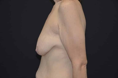 Breast lift with implants patient 25 after photo