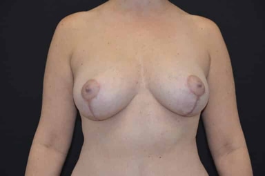 Breast lift with implants patient 22 after photo
