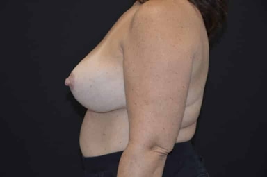Breast lift with implants patient 4 after photo