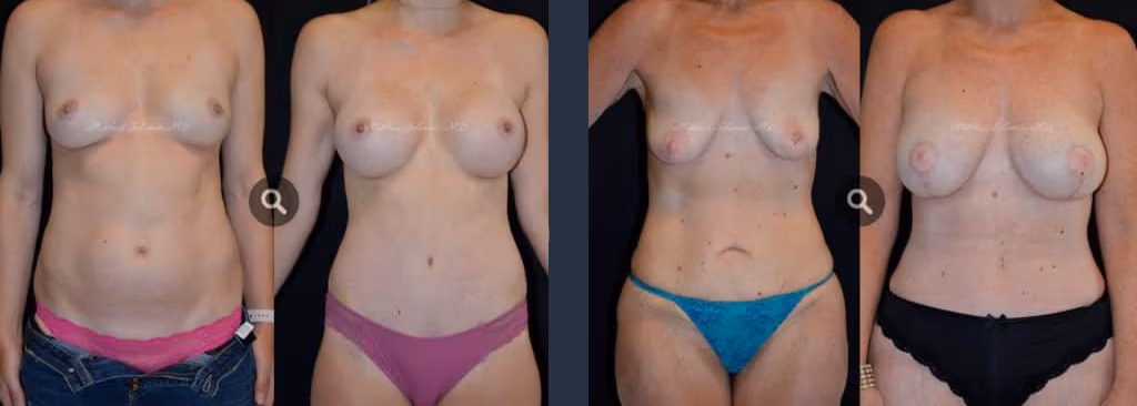 Body Contouring Plastic Surgery Before And After Photos