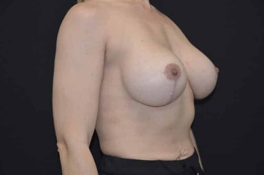 Breast lift with implants patient 28 after photo
