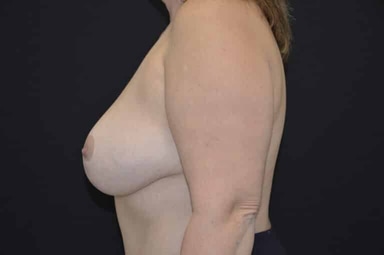 Breast lift with implants patient 32 after photo