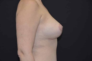 Breast lift with implants patient 22 after photo