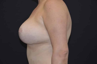 Breast lift with implants patient 27 after photo