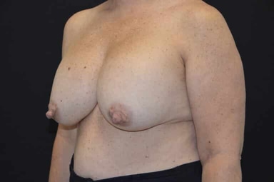Breast lift with implants patient 4 before photo