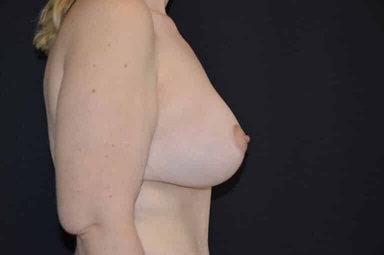 Breast lift with implants patient 15 after photo
