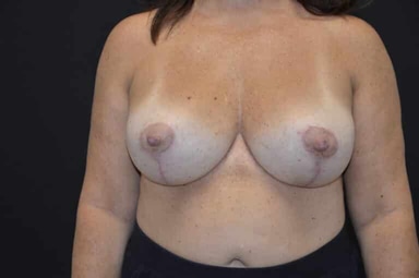 Breast lift with implants patient 4 after photo