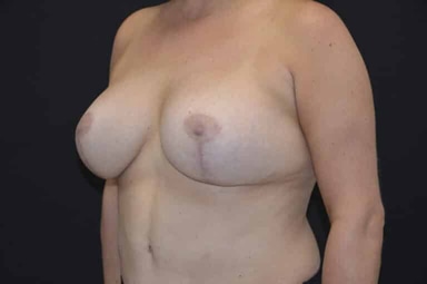 Breast lift with implants patient 27 after photo