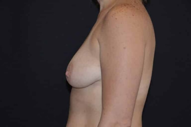 Breast lift with implants patient 25 before photo