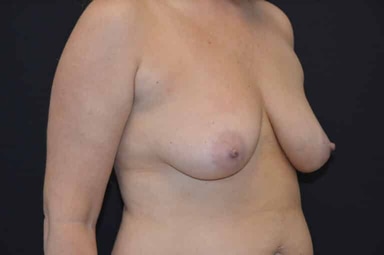 Breast lift with implants patient 2 before photo