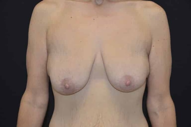 Breast lift with implants patient 25 after photo