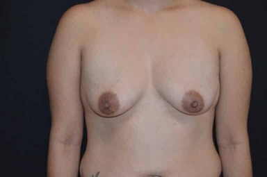 Breast lift with implants patient 24 before photo